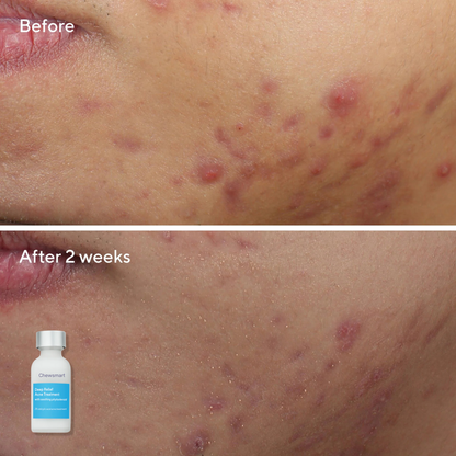 Deep Relief Acne Treatment